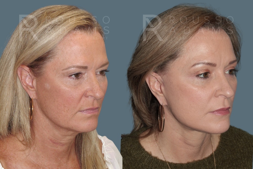 Facelift before and after, oblique view, patient one
