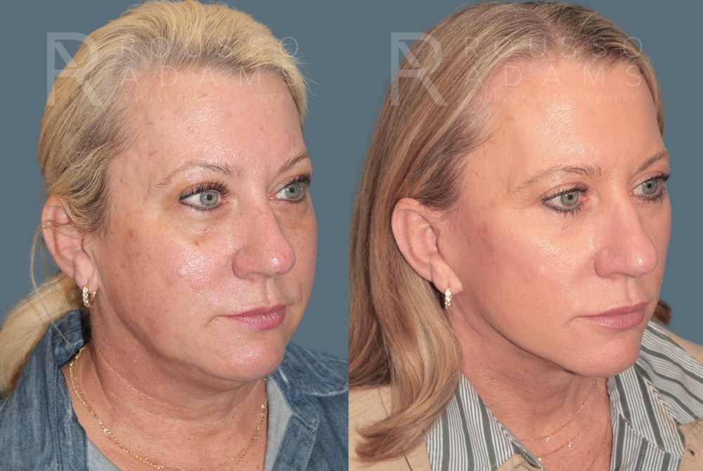 Facelift and neck lift before and after, oblique view, patient two
