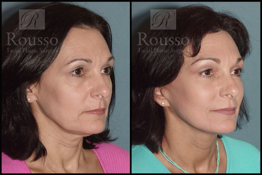Facelift before and after, oblique view, patient three