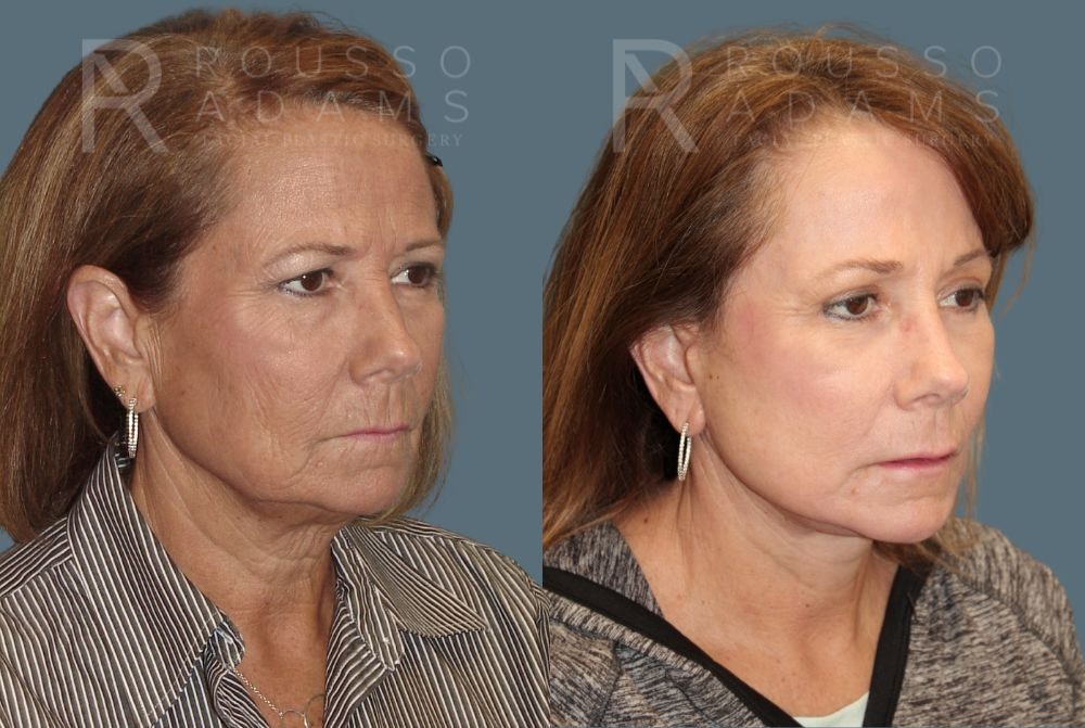 Facelift before and after, oblique view, patient four